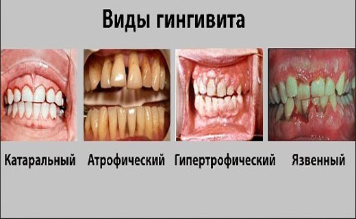симптомы гингивитиа