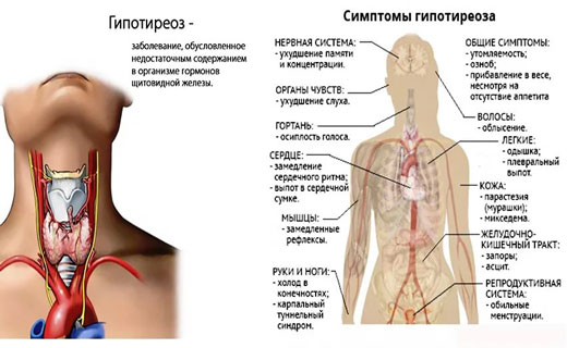 гипертиреоз