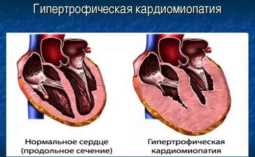 кардиомиопатия