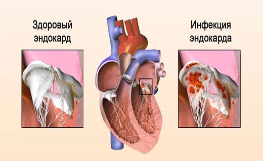 заболевания сердца