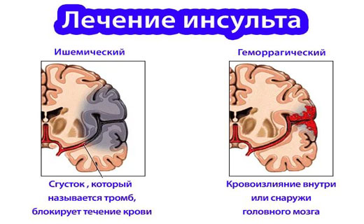 болезнь сердца