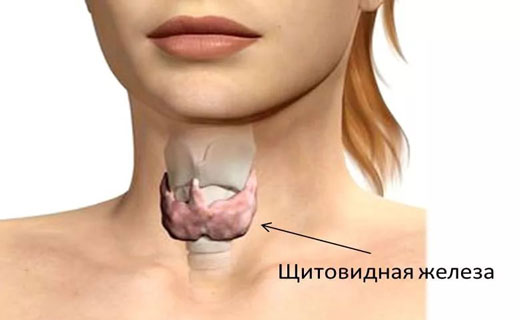 гипертиреоз