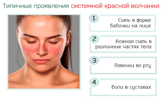 красная волчанка