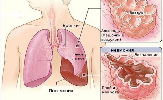 кашель