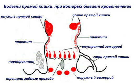 кровоточивость при дефикации