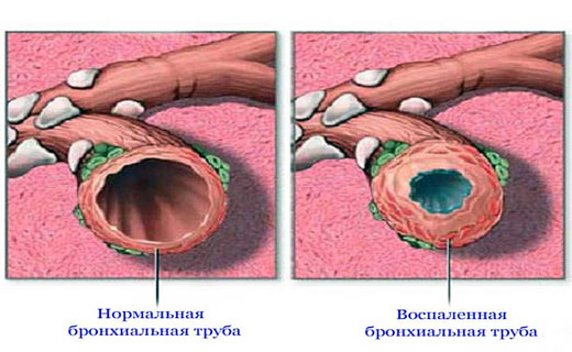 бронхит