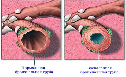 кашель