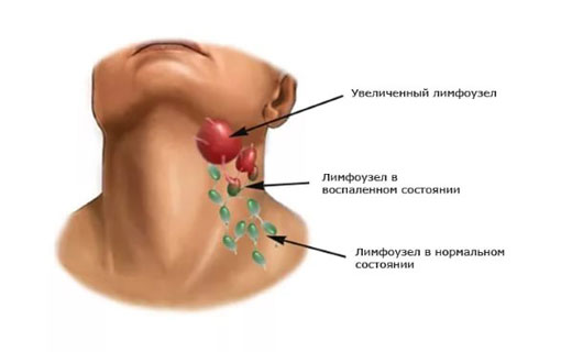 гипертиреоз