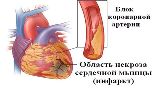 инфаркт