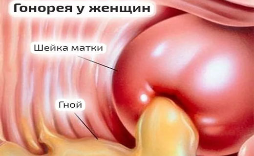 гонорея у мужчин и женщин