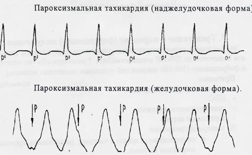 тахикардия
