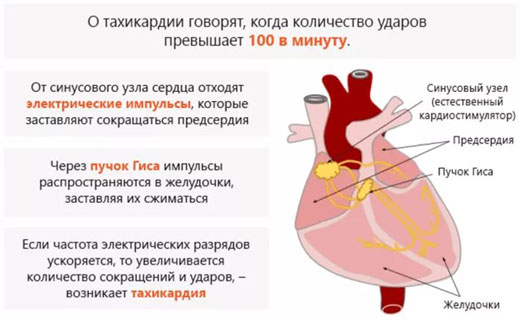 тахикардия