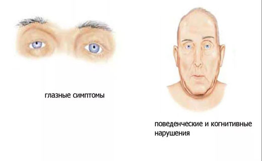 нейросифилиз