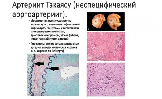 атеросклероз