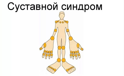 атеросклероз