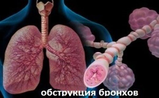 бронхит