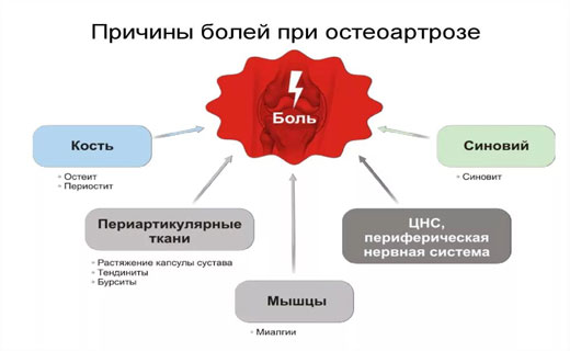 остеоартроз симптомы