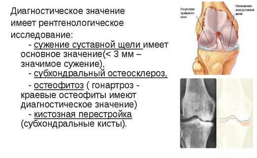 как лечить остеоартроз