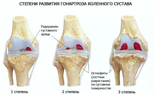 остеоартроз