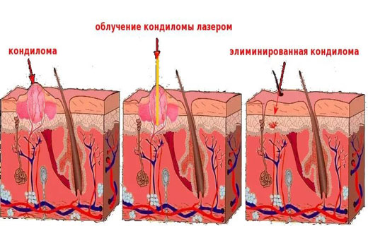во рту кандиломы