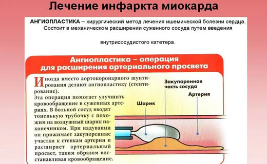 разрыв сердца