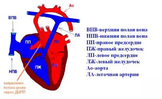атеросклероз