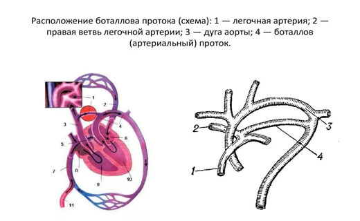 атеросклероз