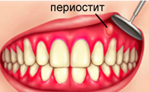 периостит