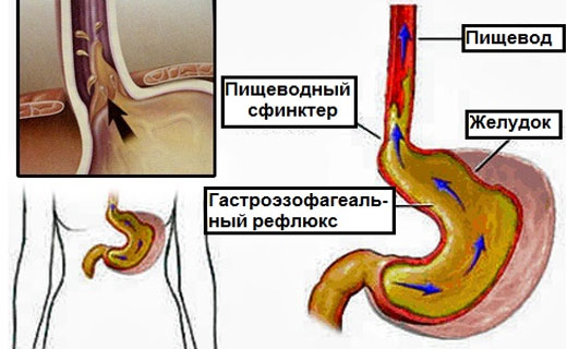 рефлюкс
