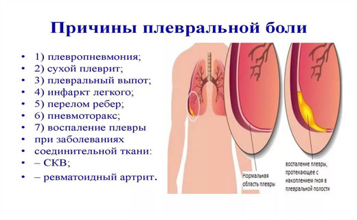 Плеврит симптомы и причины, Диагностика плеврита Плеврит симптомы и причины, Диагностика плеврита