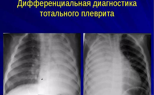 Плеврит симптомы и причины, Диагностика плеврита Плеврит симптомы и причины, Диагностика плеврита