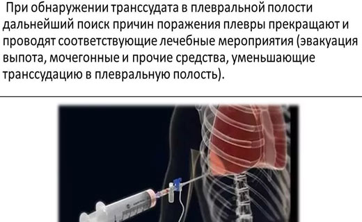 Плеврит симптомы и причины, Диагностика плеврита Плеврит симптомы и причины, Диагностика плеврита