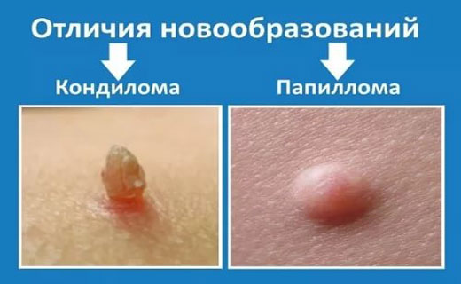 во рту кандиломы