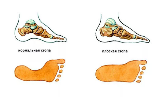 плоскостопие