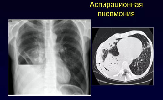 пневмания