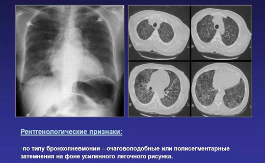 пневмания