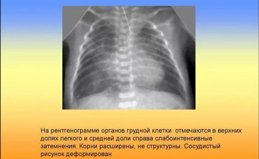 пневмания