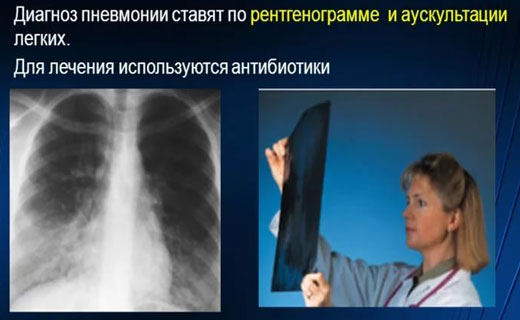Как лечить воспаления лёгких в домашних условиях 963