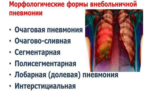 пневмания