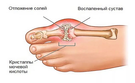 подагра