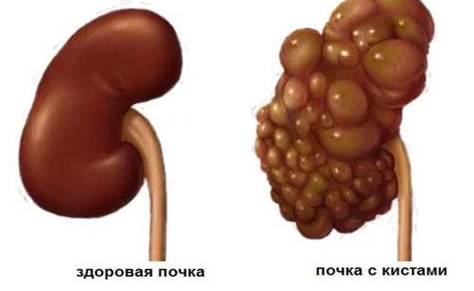почки