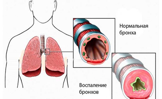 астма