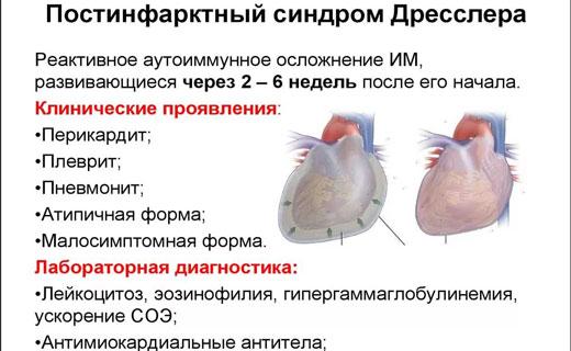 атеросклероз