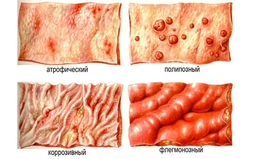 виды поражений слизистой оболочки кишечника