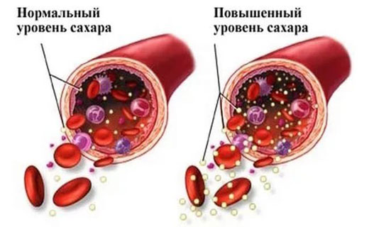 повышенный сахар в крови