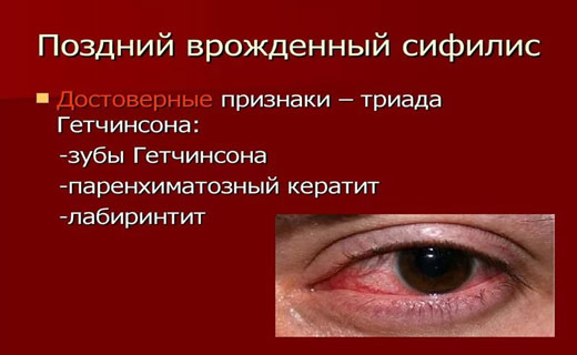 поздний сифилис
