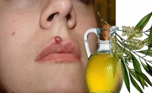 кандиломы