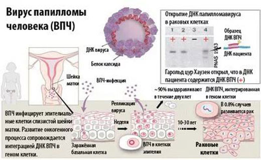 кандиломы