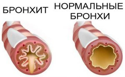 бронхит