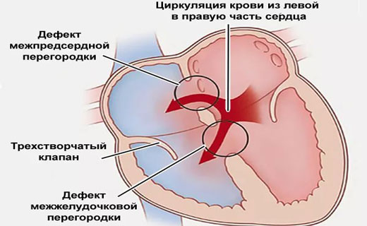 атеросклероз